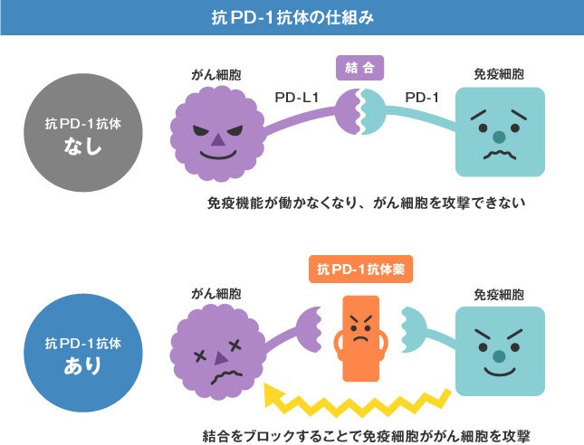 「腎がん」に有効な新免疫療法が登場　日本でも患者テストが進みつつある