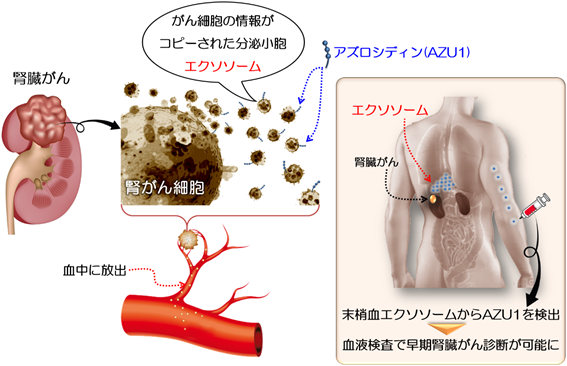 早期発見が難しい腎臓がん 血液検査で判別 がん研究会が 目印 のタンパク質を発見 J Cast ニュース 全文表示