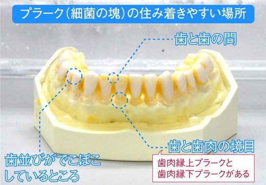 歯ブラシだけでプラークを落とすのは困難